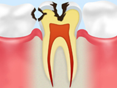 中期のむし歯（象牙質のむし歯）