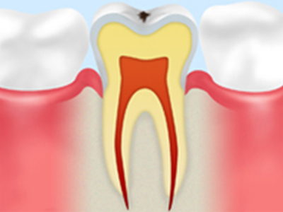 初期のむし歯（エナメル質のむし歯）