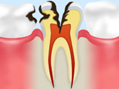 重度のむし歯（神経に達したむし歯）