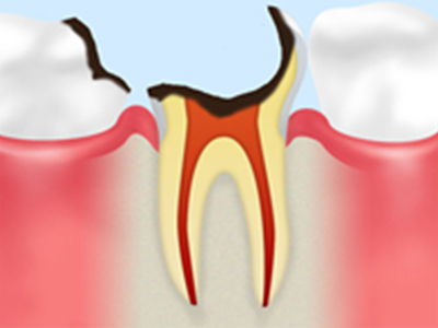 末期のむし歯（歯根に達したむし歯）