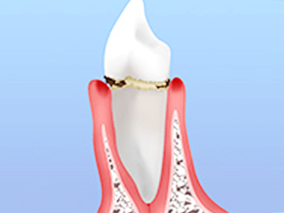 初期段階（歯肉炎）