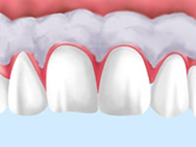 歯肉のホワイトニング　～歯肉の黒ずみが気になる方へ～